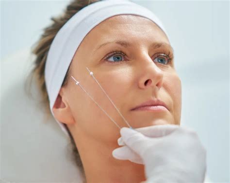 Image result for Thread Lift