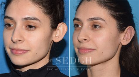 Ear Pinning Surgery Before and After Photos | Dr. Sedgh