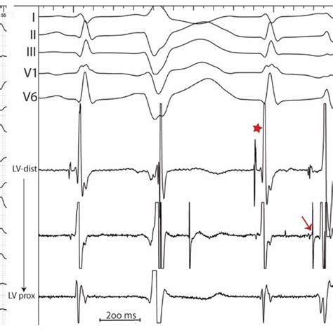 Image result for PVC Localization