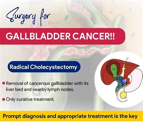 Gallbladder Cancer Treatment and Surgery | Dr. Nikhil Agrawal | Best in ...