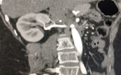 Image result for Hand-Assisted Nephrectomy