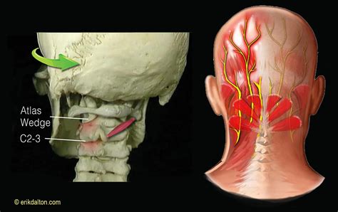 Occipital Neuralgia: Symptoms And Treatments – ETKTD