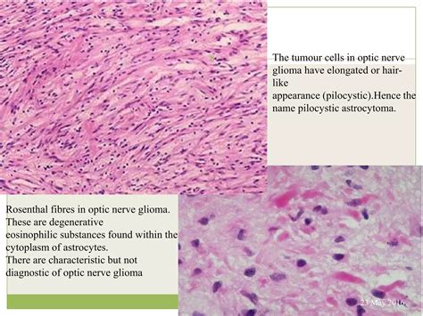 Optic pathway glioma | PPTX
