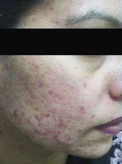 Best Treatment for Acne Pimples in Vasant Kunj South Delhi.