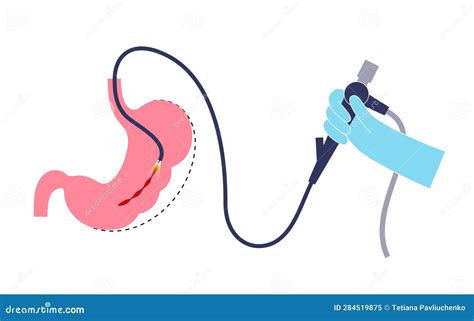 Endoscopic Sleeve Gastroplasty Stock Vector - Illustration of obesity, digestive: 284519875