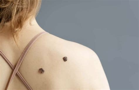 Te enseñamos el método “A, B, C, D, E” para identificar un melanoma – Hospital San Francisco Pucón
