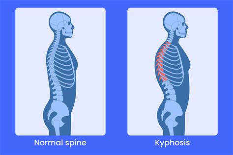 Regions Of The Spine Demonstrate Kyphotic Curves