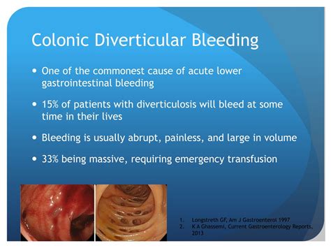 PPT - Colonic Diverticular Bleeding: Causes, Pathophysiology, and Management PowerPoint ...