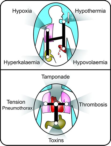 Resuscitation Council (UK) - Advanced Life Support - Cardiac Arrest ...
