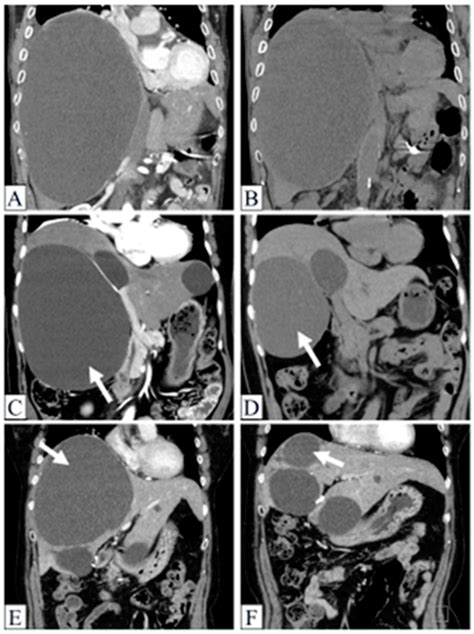 The Treatment Effects of Percutaneous Drainage with or without Sclerotherapy for Symptomatic ...