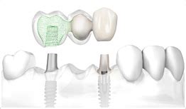 Dental Implants, Best Implantologist in Gurgaon Major service provided ...