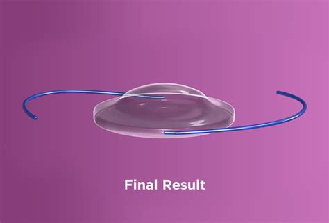 Image result for Light Adjustable Lens Problems