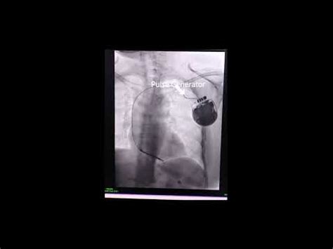 Risks and Complications Associated with AICD Implantation | ArogyaJivan
