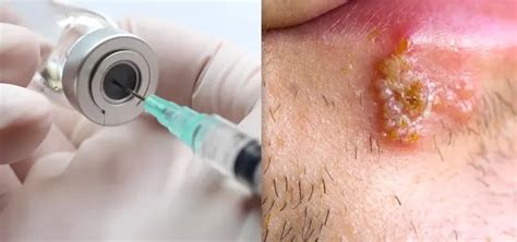 Understanding the human papillomavirus (HPV) infection