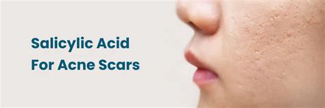 Benefits of Salicylic Acid for Acne Scars