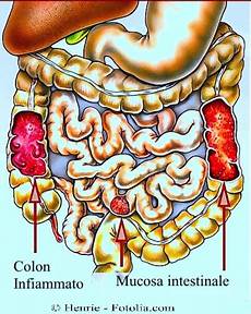 alimentazione per colon infiammato colon infiammato sintomi cause intestino colonscopia alimentazione per colon infiammato colon infiammato sintomi cause intestino colonscopia
