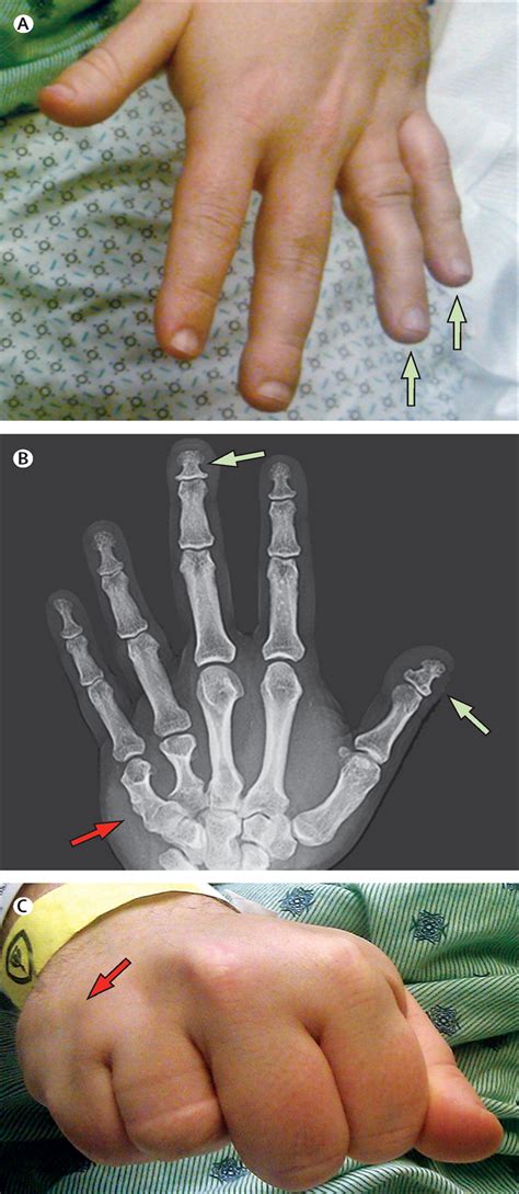 Pseudopseudohypoparathyroidism - The Lancet