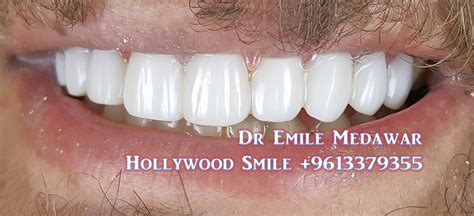 Composite Veneers Lebanon