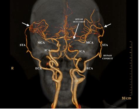 Moyamoya Disease Portal - Sree Chitra Tirunal Institute for Medical ...