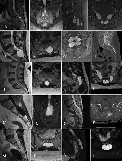 Sacral Tarlov perineurial cysts: a systematic review of treatment options in: Journal of ...