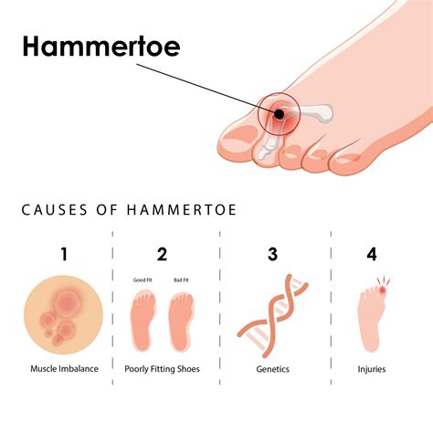 What Causes Hammertoe