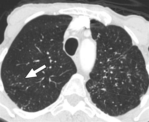 What Is Lung Nodular Density at Nadia Arsenault blog