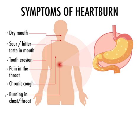 Symptoms of heartburn information infographic 1520288 Vector Art at Vecteezy