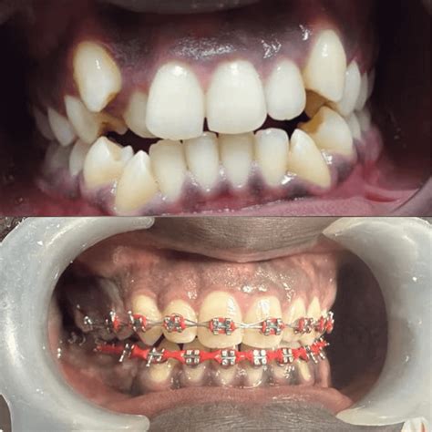 Braces On Crooked Teeth