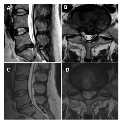 Video: Full Endoscopic Interlaminar Approach for Paracentral L5-S1 Disc Herniation