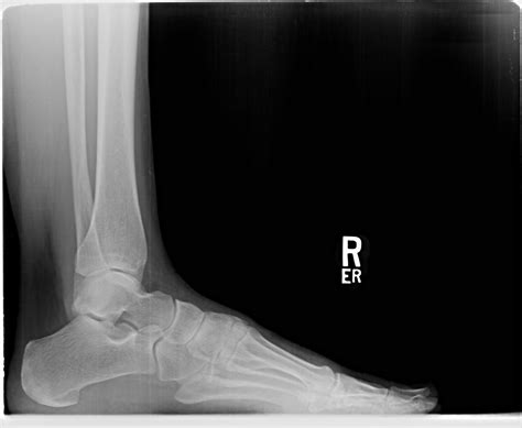 Labeled Lateral Ankle Xray at Albert Glover blog