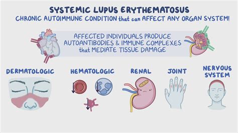 Systemic lupus erythematosus: Clinical sciences - Osmosis Video Library