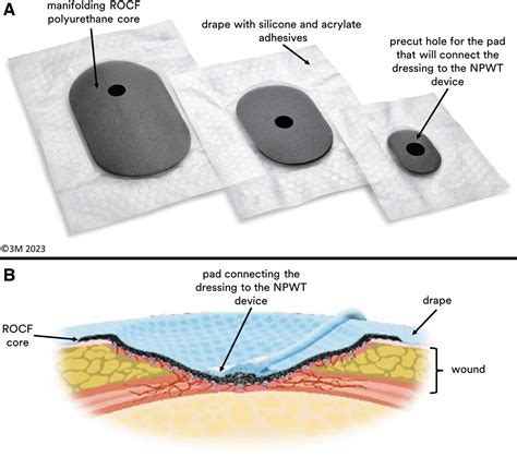 Preclinical Assessments of a Novel Peel and Place Extended-Wear Negative-Pressure Wound Therapy ...