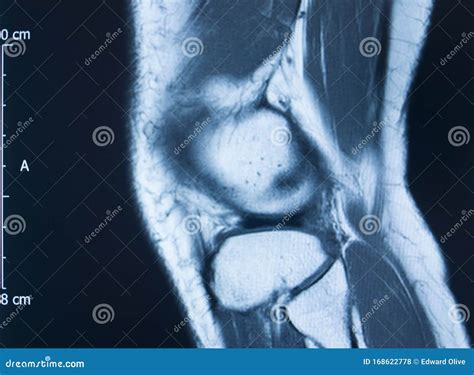 Knee injury mri mcl tear stock photo. Image of exam - 168622778
