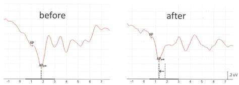 Use of an Extra-Tympanic Membrane Electrode to Record Cochlear ...