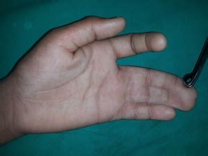 Paediatric Hand Disorders | Shubhamkar hand clinic