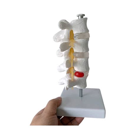Buy Lumbar disc herniation Demonstration Model Cervical Vertebra ...