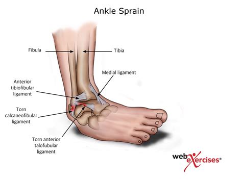 Ankle Sprain - Treat The Athlete