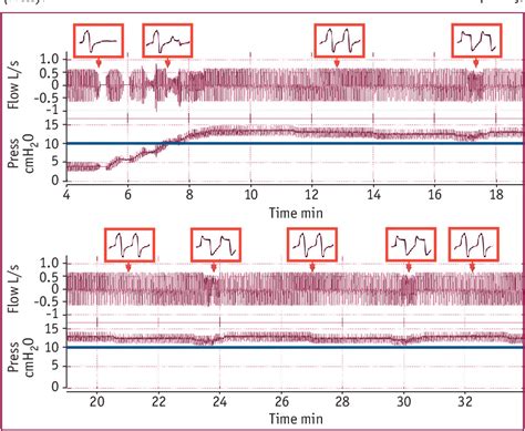 Image result for CPAP FiO2