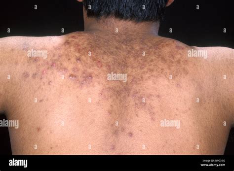 Image result for Sebum Plug Extraction