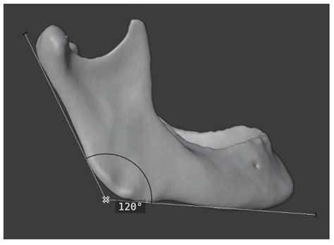 Clinical Comparison of CAD/CAM vs. KLS L1® Mandible ReconGuide in ...