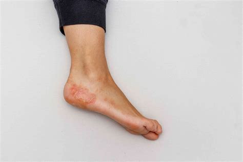 What Is A Skin Rash And How To Treat It Marietta Foot