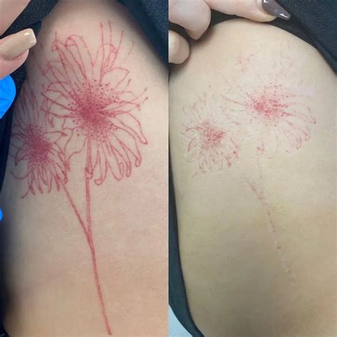 Tattoo Removal Ink