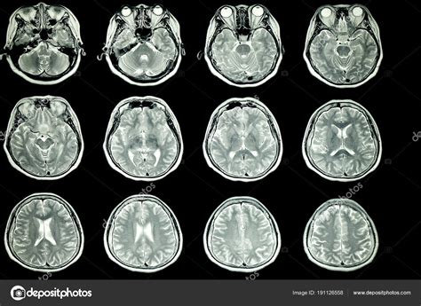 Mri Normal Brain Scan
