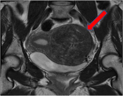 An Atypical Presentation of a Uterine Fibroid - The Journal for Nurse ...
