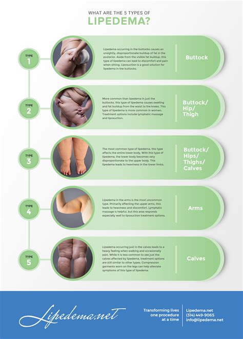 » Lipedema Definitions and Explanation - Lipedema