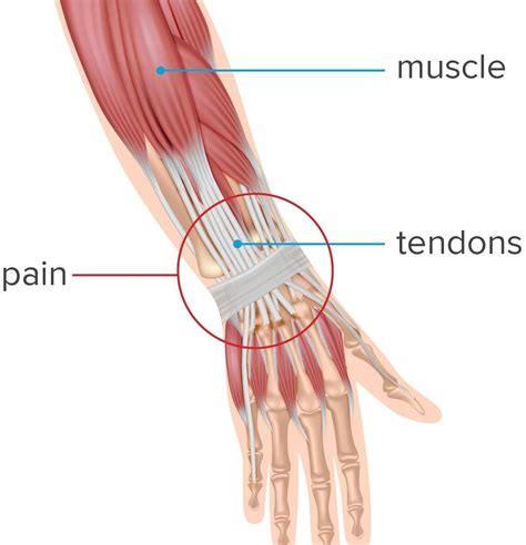 Wrist Tendonitis Surgery