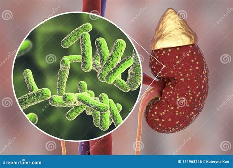 Pyelonephritis, Medical Concept, And Close-up View Of Bacteria, The Common Causative Agent Of ...