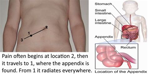 Image result for Appendix Exploded