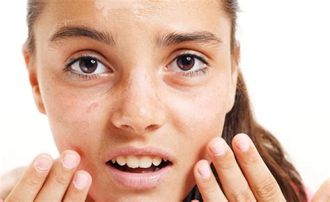 धूप से जले चेहरे को इन नुस्खों से करिए ठीक, खुजली और जलन भी होगी शांत ...