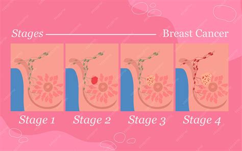 Premium Vector | Stages of breast cancer infographic awareness flat illustration